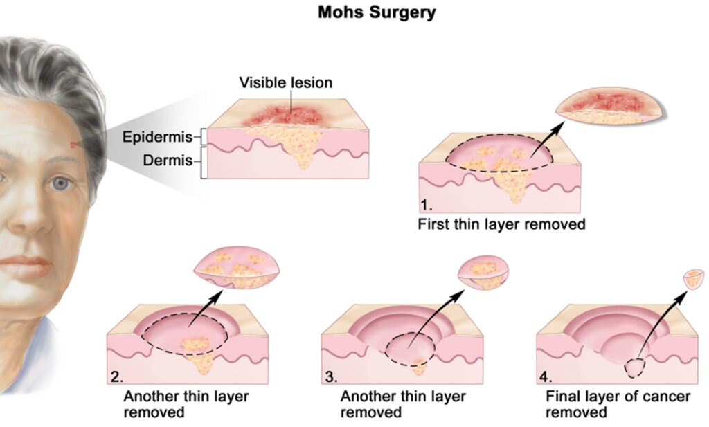 Mohs Surgery-2