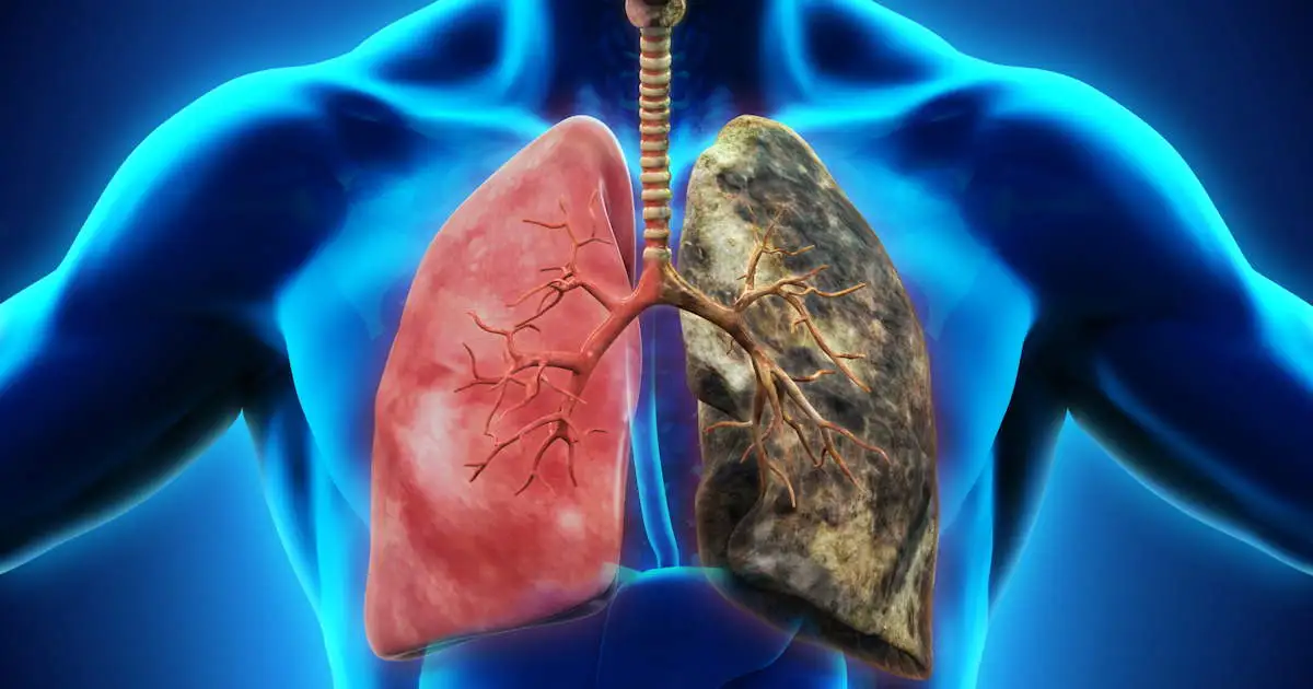 Lung Cancer Stages