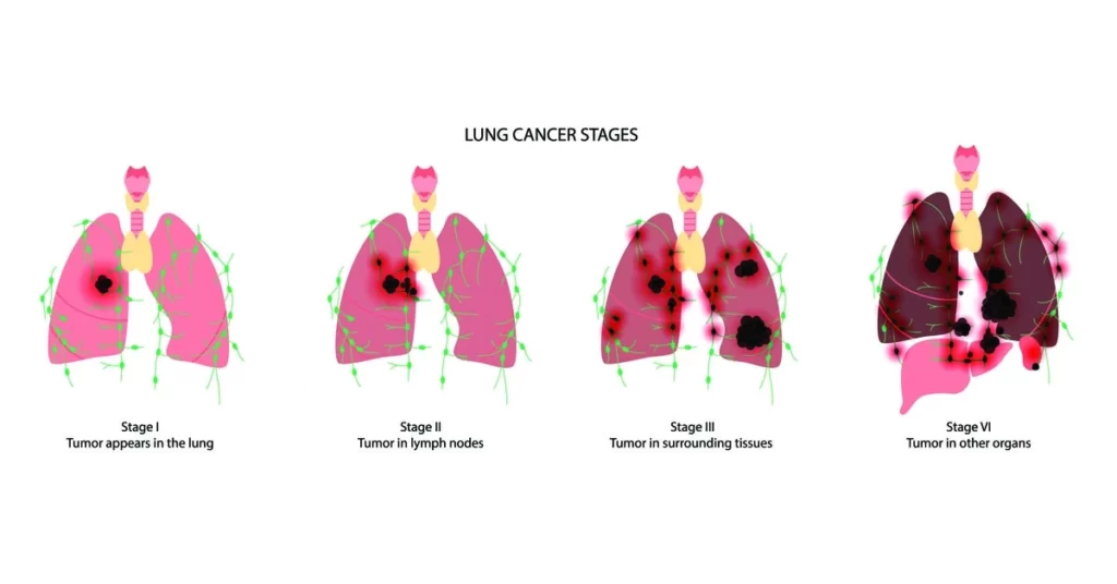 lung-cancer-stages1