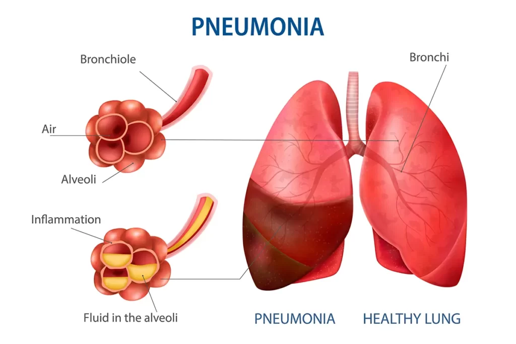 multifocal pneumonia